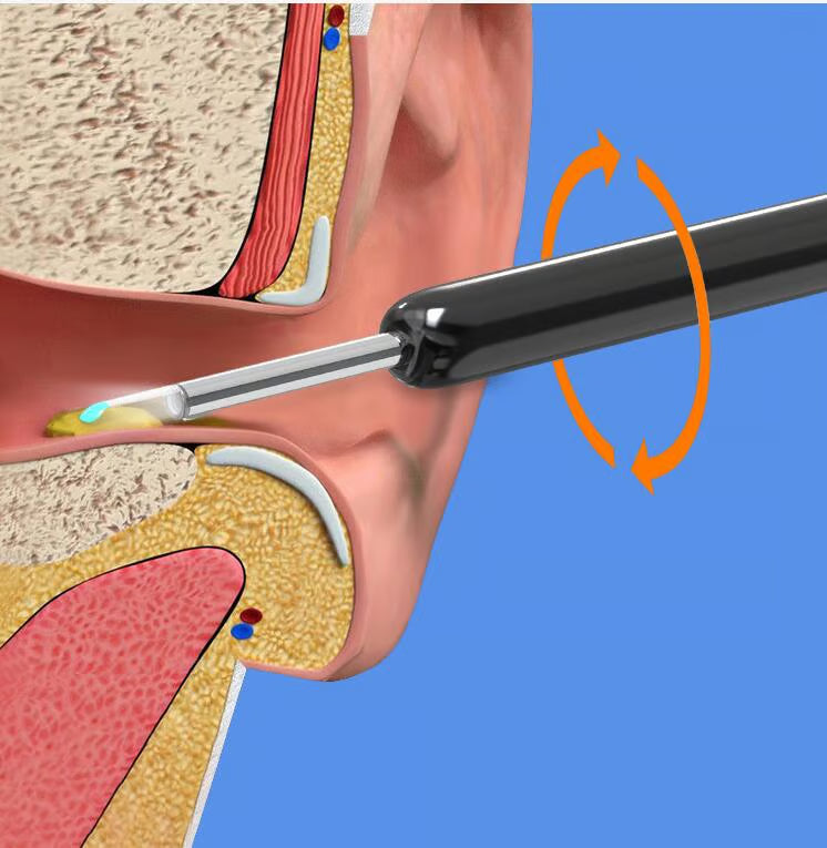 Earwax Removal with Camera