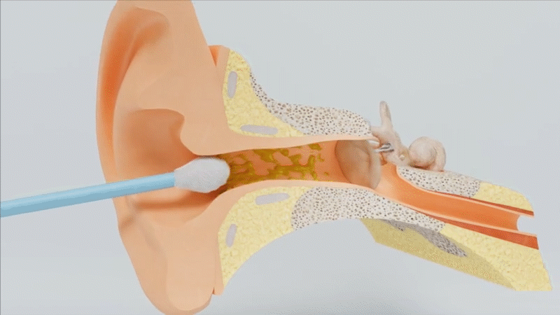 Earwax Removal with Camera